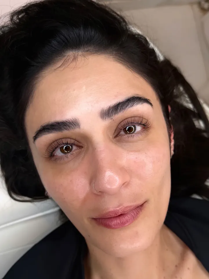 Cliente après un brow lift